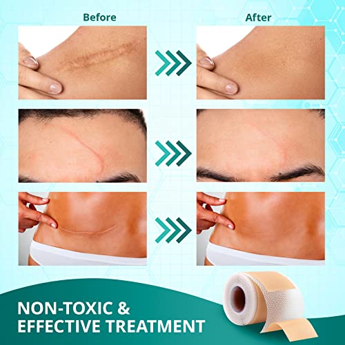 Silicone Scar Sheets for Surgical Scars, Keloid, C-Section, Tummy Tuck H3296