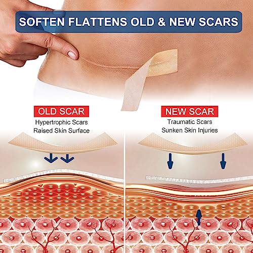 Silicone Scar Sheets Roll for C-Section, Surgery, Burn, Keloid, Acne P55830