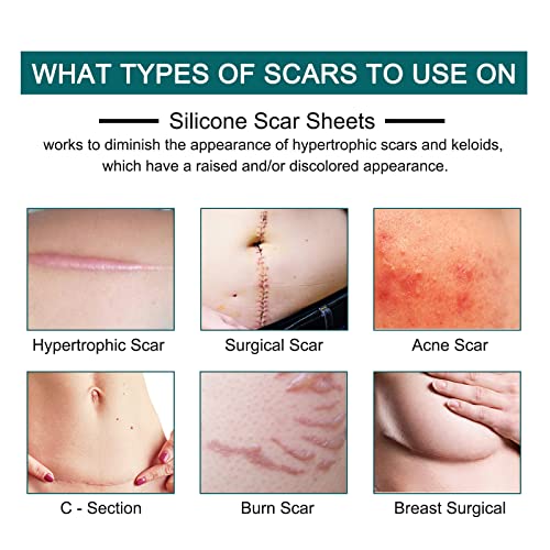 Silicone Scar Sheets Roll for C-Section, Surgery, Burn, Keloid, Acne P55830