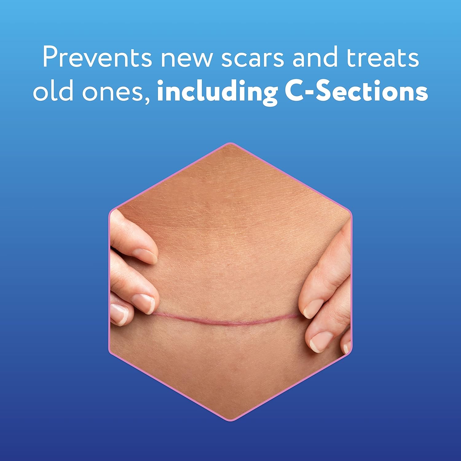 ScarAway Advanced Silicone Scar Sheets for C-Section, Reusable, 4 Sheets W53497