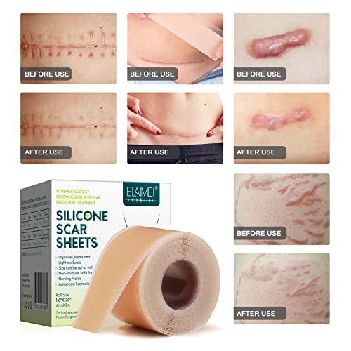 Silicone Scar Sheets Roll for C-Section, Surgery, Burn, Keloid, Acne P55830